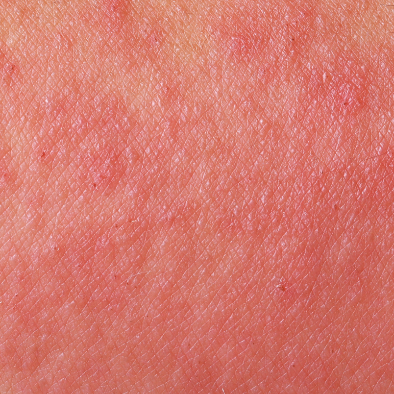 7 Types of Eczema: Causes + Symptoms