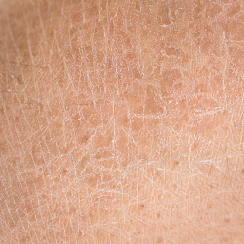 10 Everyday Things That Dry Your Skin Out