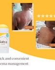 Eczema Easy Glide Stick