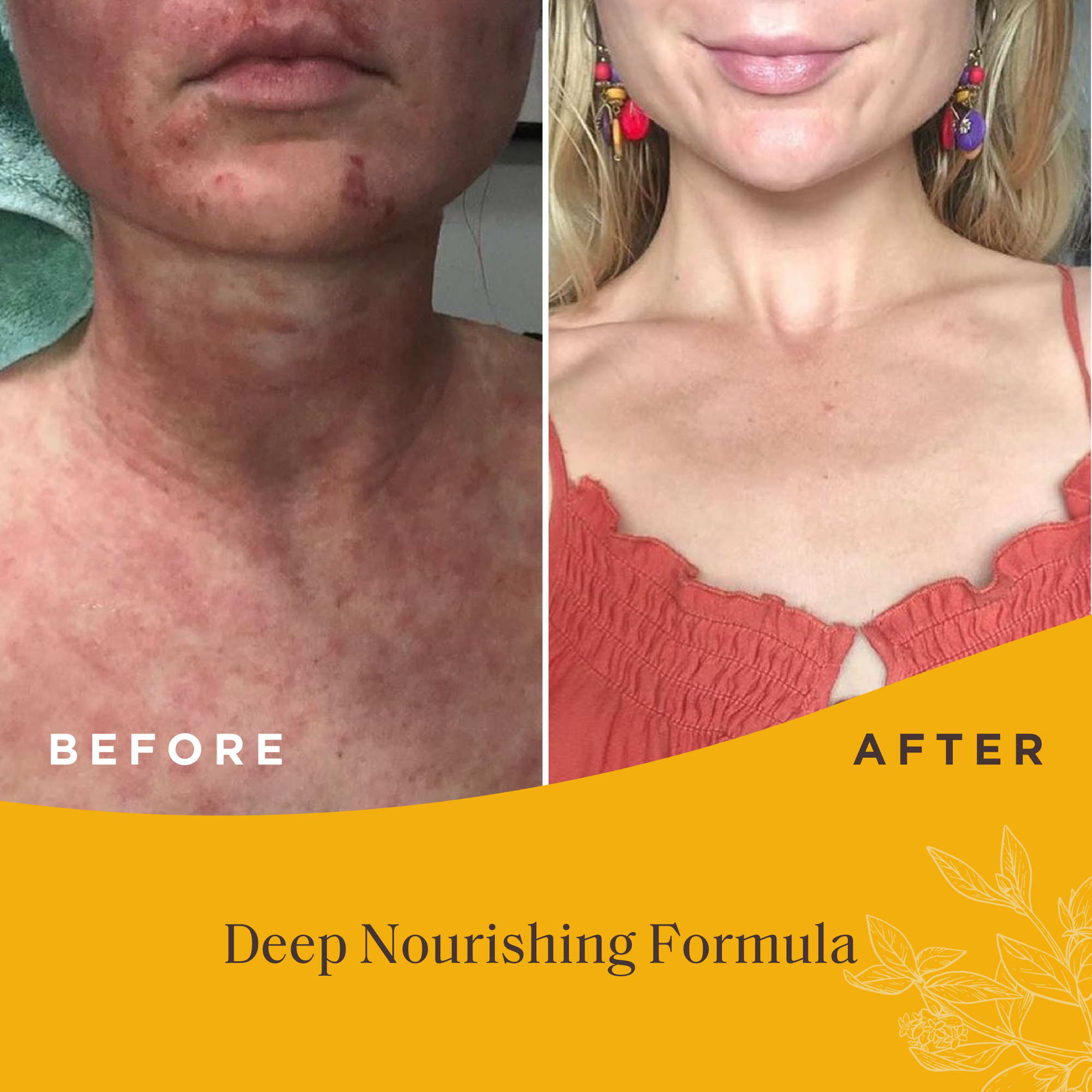 Eczema Jar - 2 Pack