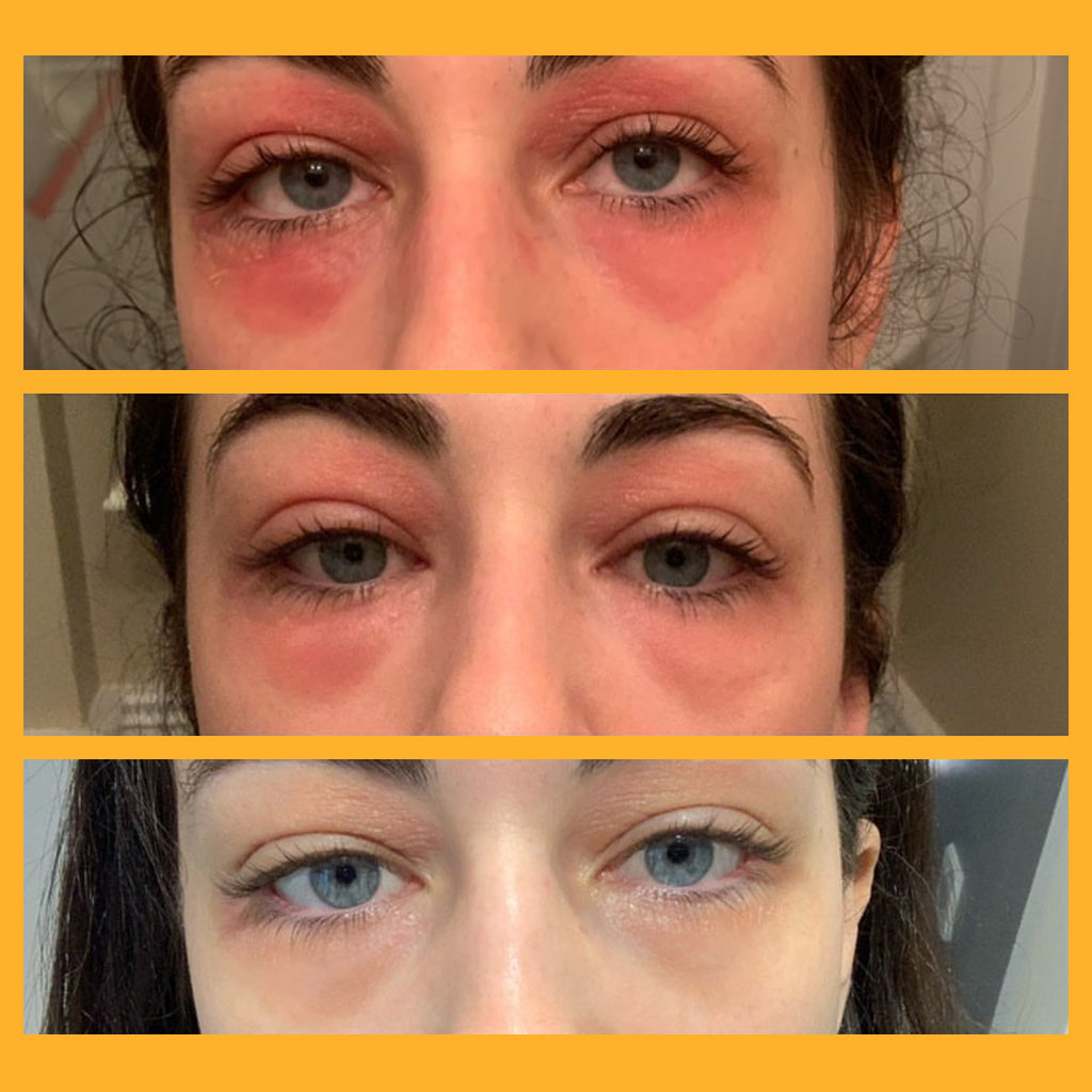 Eyelid Eczema: What Is It and Why Do I Have It?