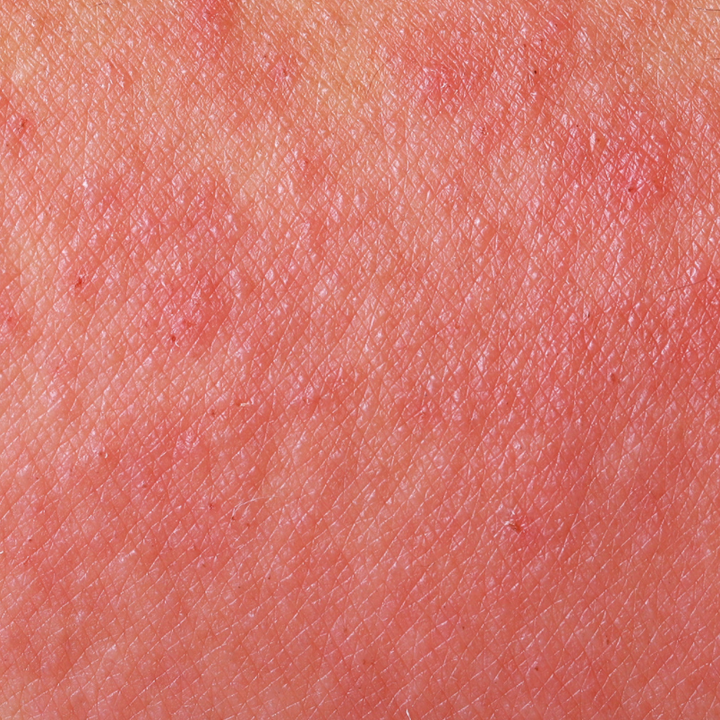 7 Types of Eczema: Causes + Symptoms – Satya Organic Eczema Relief