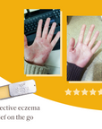 Eczema Travel Tins -12 Pack